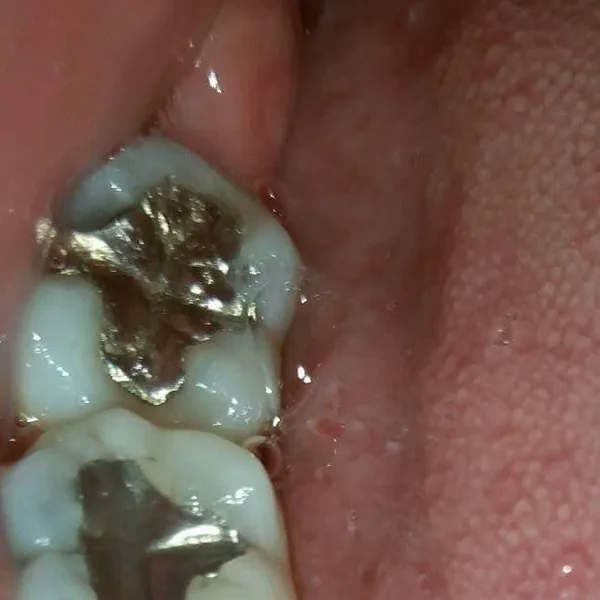 Muelas de oro y plata documentadas